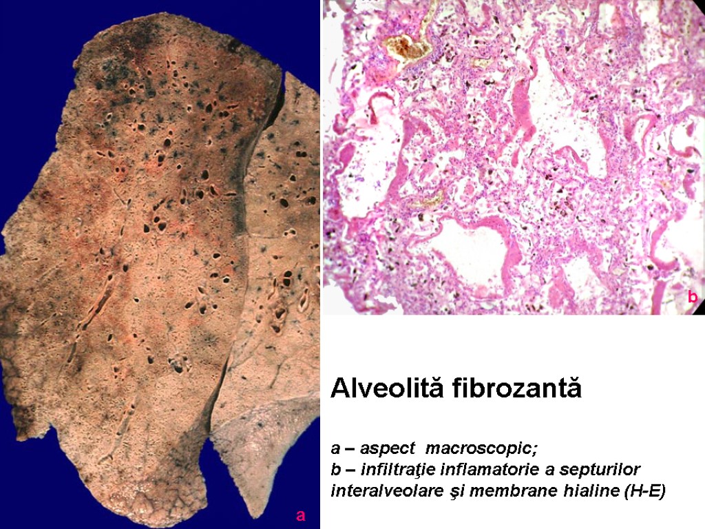 Alveolită fibrozantă a – aspect macroscopic; b – infiltraţie inflamatorie a septurilor interalveolare şi